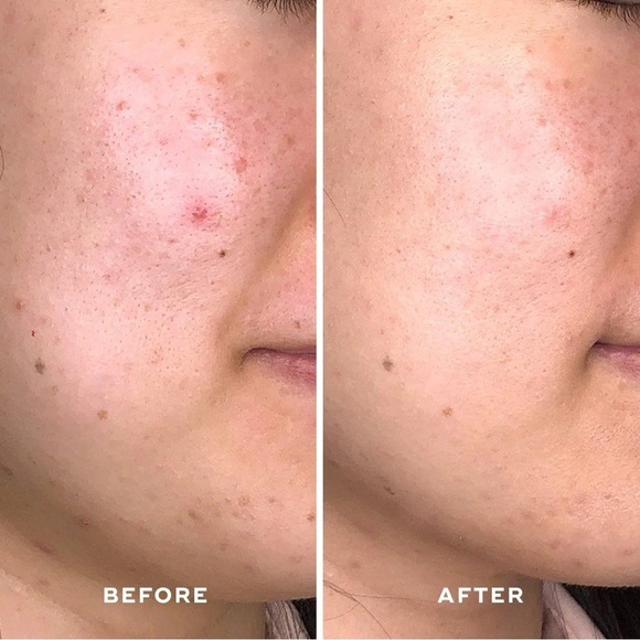 Aceology Detoxifying Treatment Mask - Picture 6 of 11